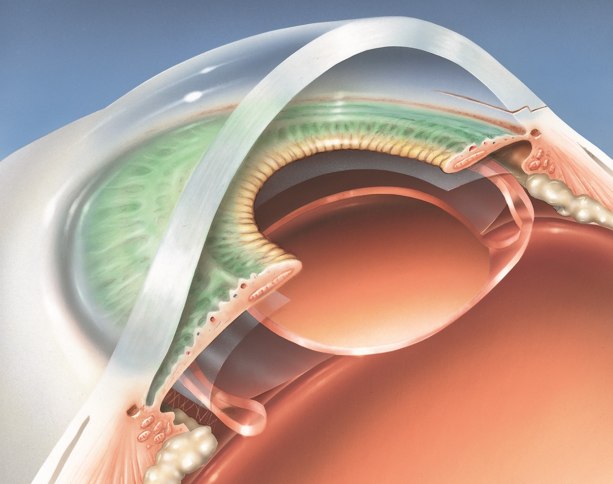 Cataract Surgery
