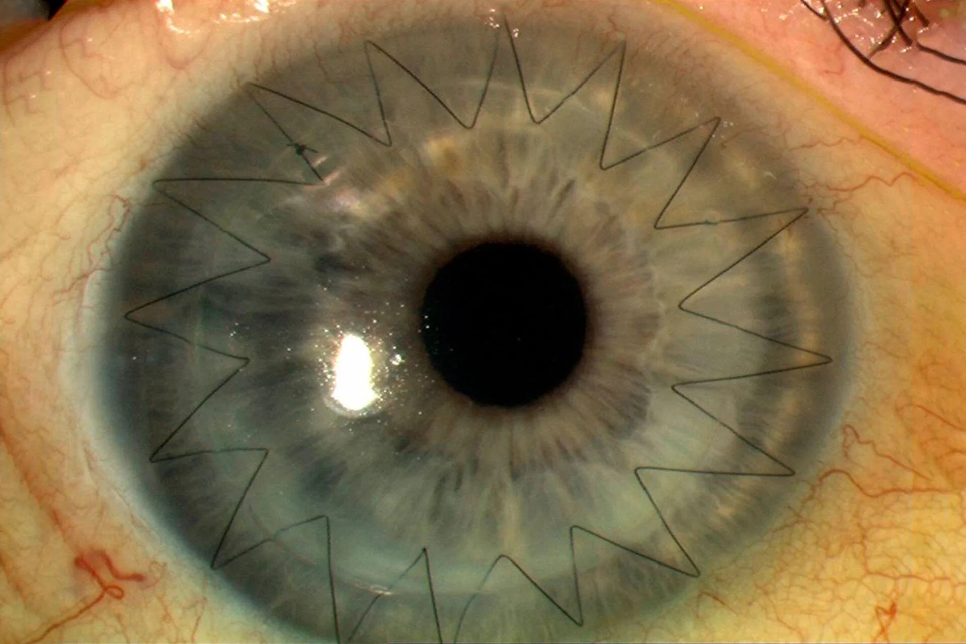 Corneal Transplant