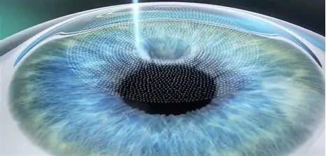 Vision Correction – FemtoLASIK & FemtoSMILE